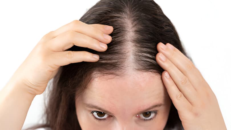 Tratamiento de alopecia femenina en Santander