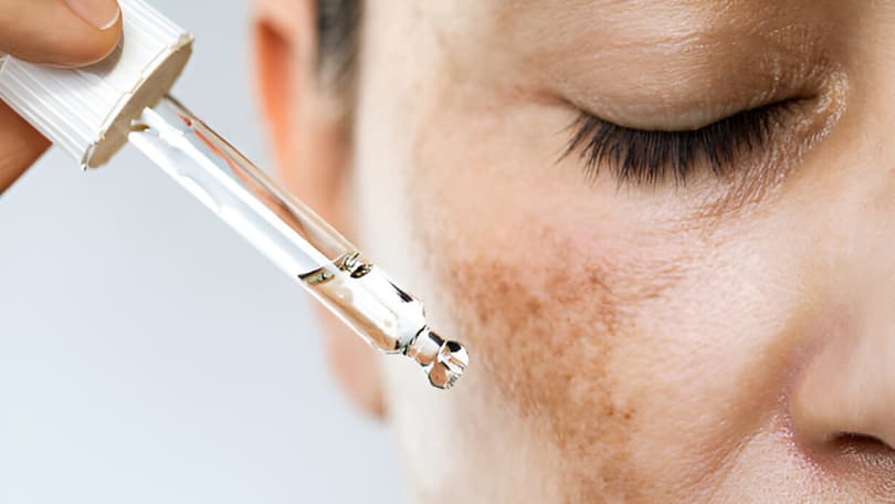 Tratamientos de melasma y pigmentación en Santander