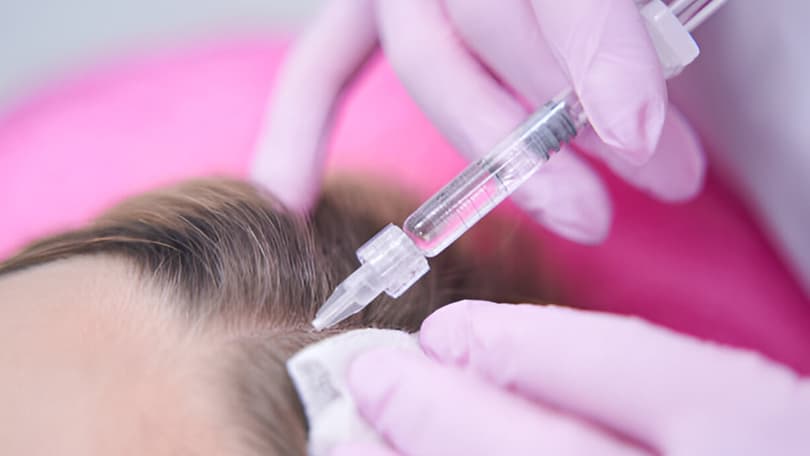 Tratamiento de mesoterapia capilar en Santander