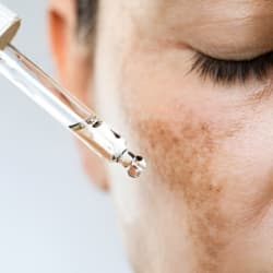 Tratamiento para melasma en Santander
